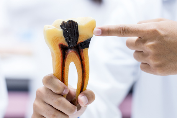 Why Root Canals Are An Effective Tooth Infection Treatment