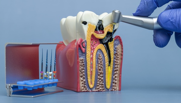 Tips To Prepare For Root Canal Therapy